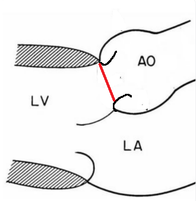 Схема измерения фиброзного кольца от внутреннего края к внутреннему