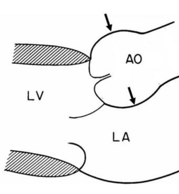 Схема измерения аорты методом Leading edge to leading edge
