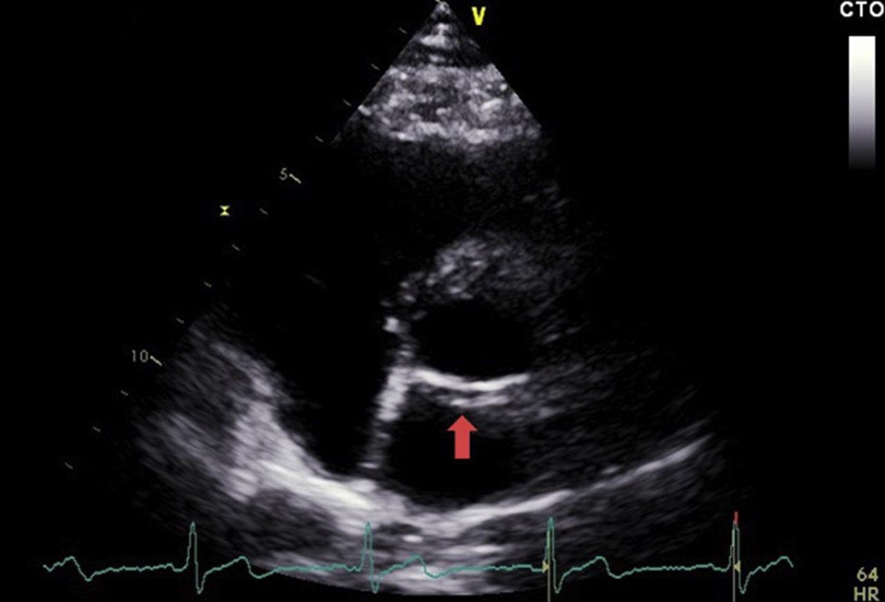 Туннелеобразная структура позади корня аорты
