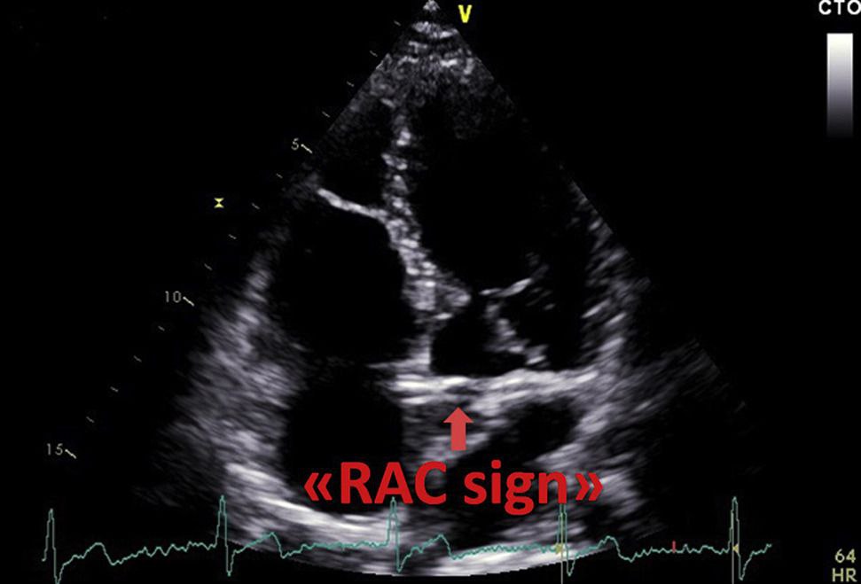RAC-sign в апикальной четырехкамерной позиции
